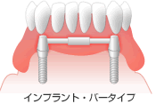 Case3: 全ての歯を失った場合